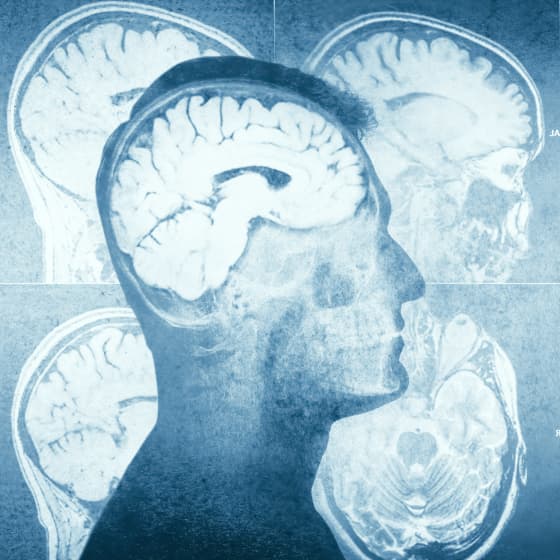 Can You Prevent Alzheimer's By Keeping Your Brain Active