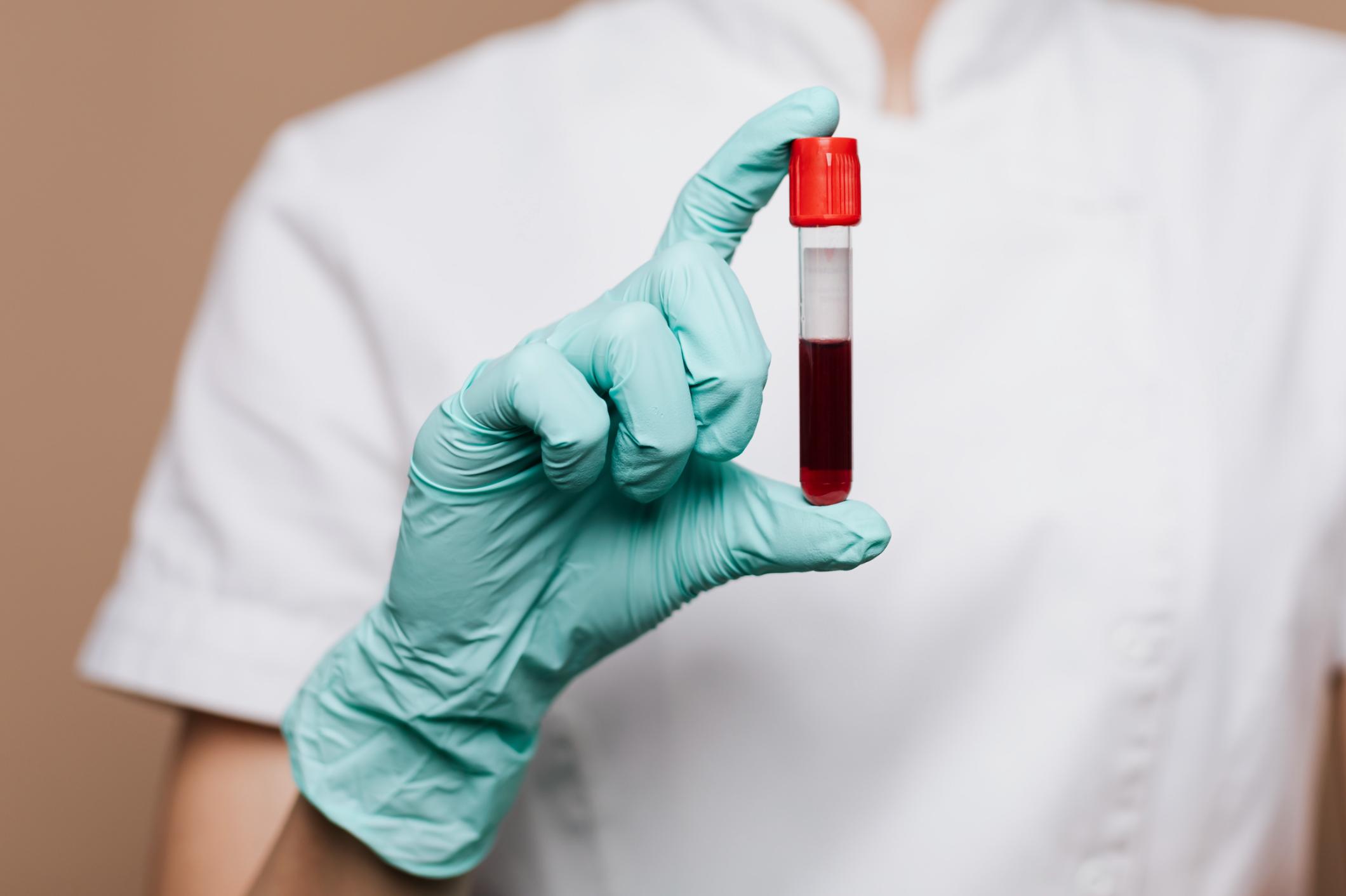 Breakthrough in Alzheimer’s Detection: The Blood Test Changing the Game